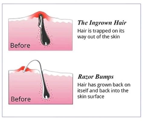 The Magic Eraser: The Ultimate Tool for Quick Hair Removal